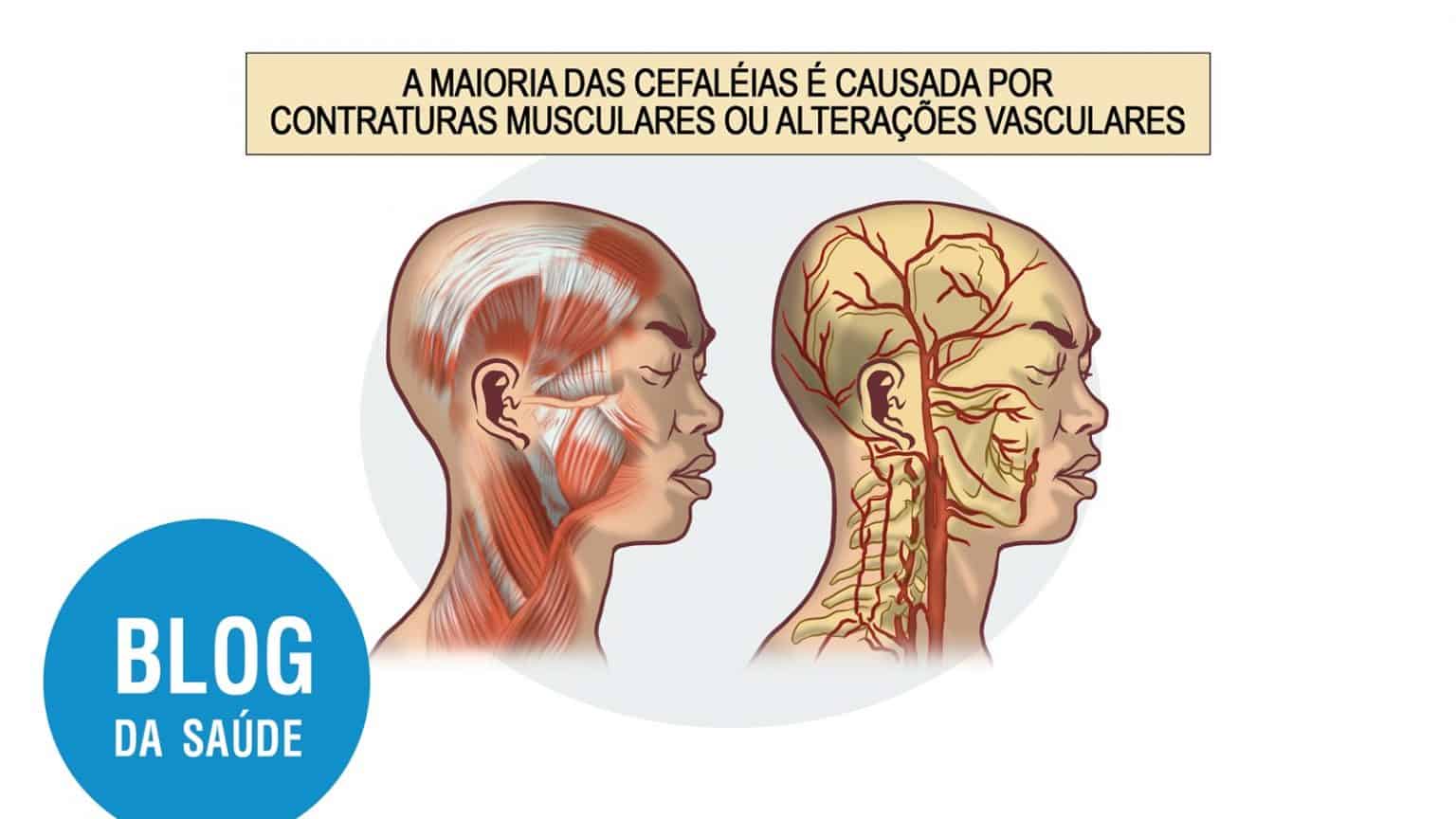 Neuralgia Occipital Neuropatia De Arnold Blog Da Sa De