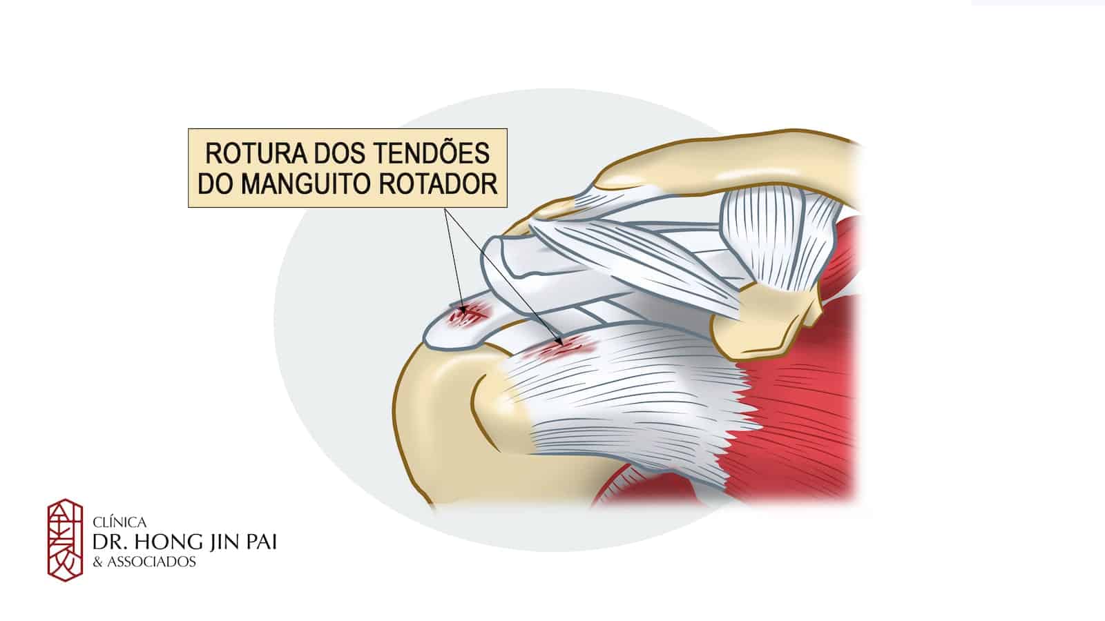 Rotura dos tendoes do manguito