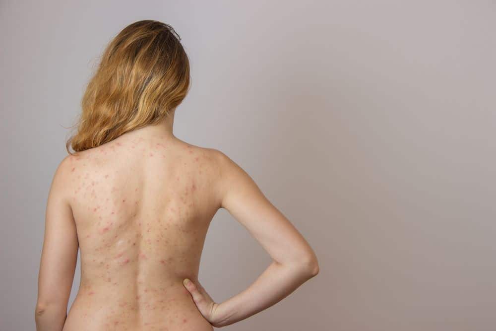 acne nas costas