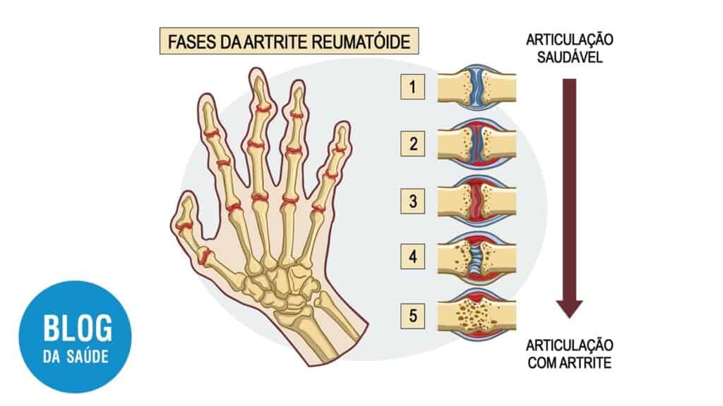 artrite reumatoide mao