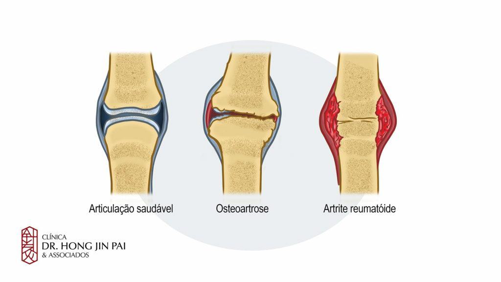 artrose artrite reumatoide osteoartrose