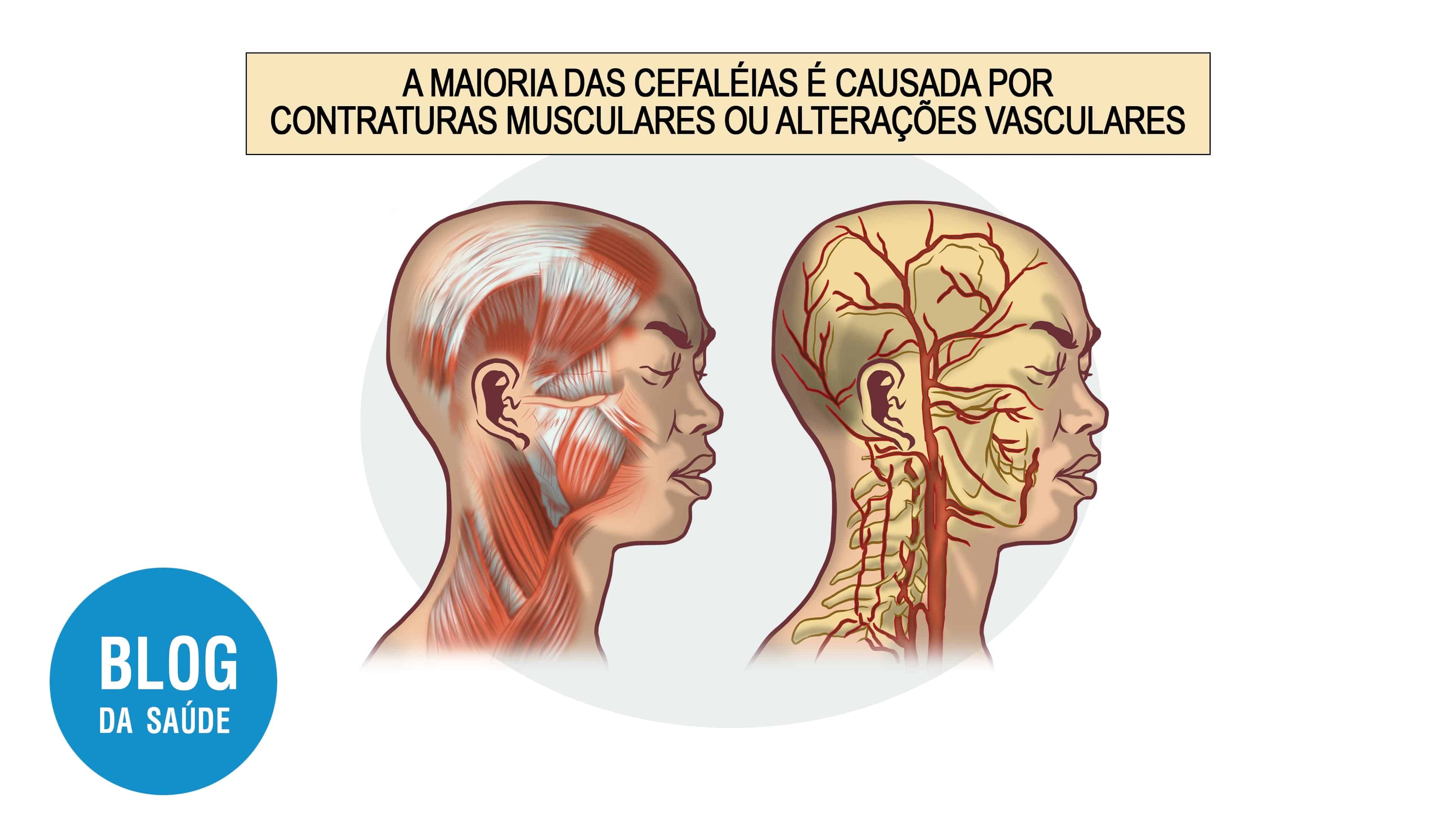 cefaleia tensional 2