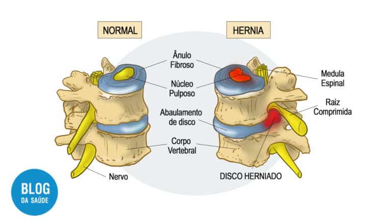 Nódulo De Schmorl Blog Da Saúde