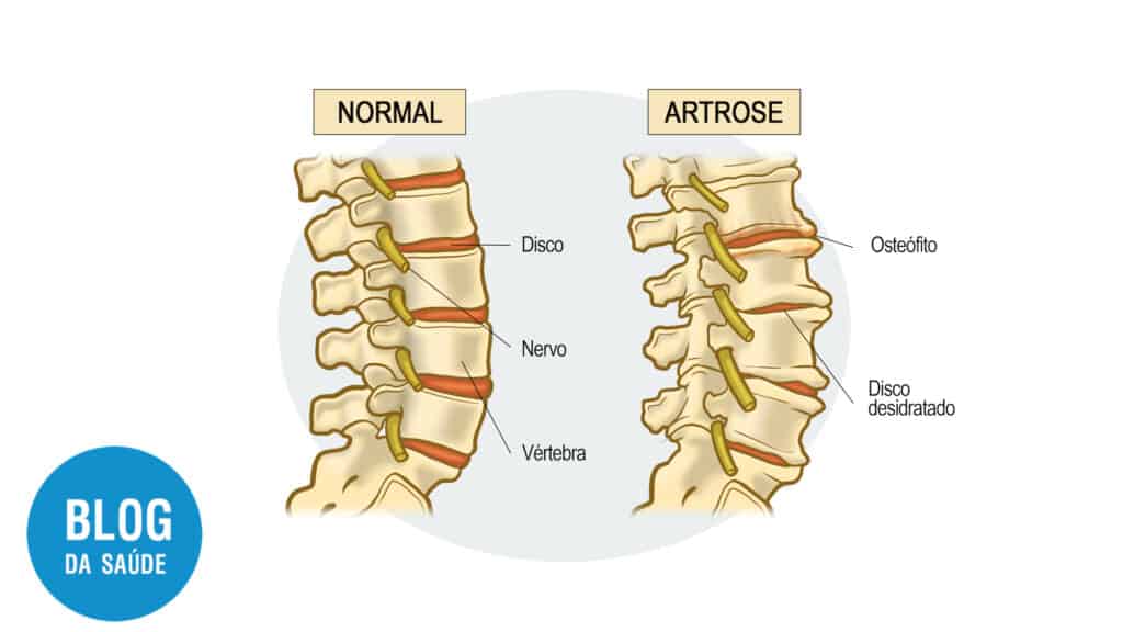 coluna normal vs artrose