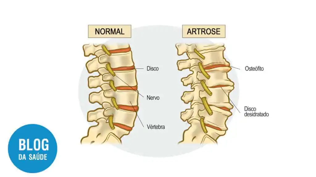 coluna normal vs artrose com bico de papagaio osteofito