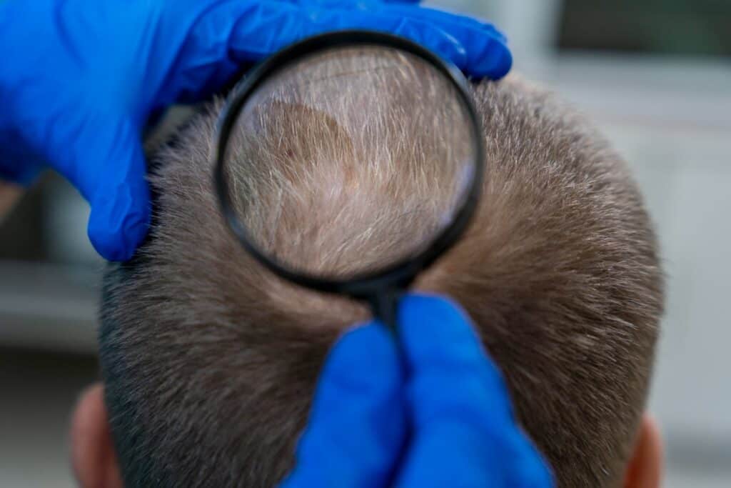 creatina alopecia androgenetica queda de cabelos