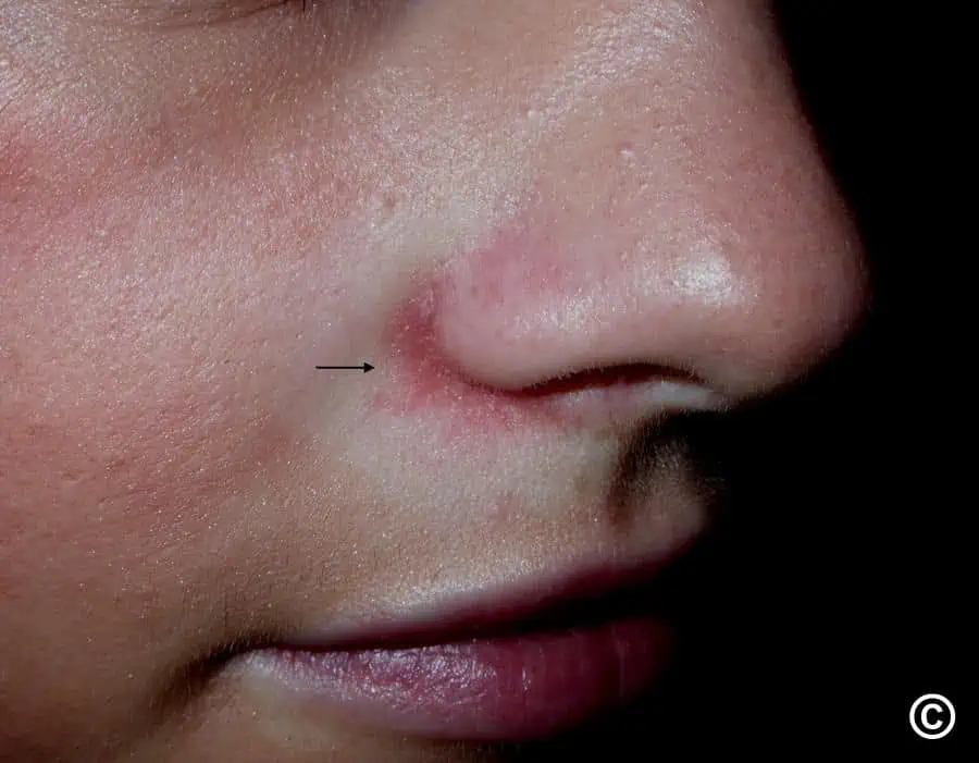 dermatite perioral no nariz