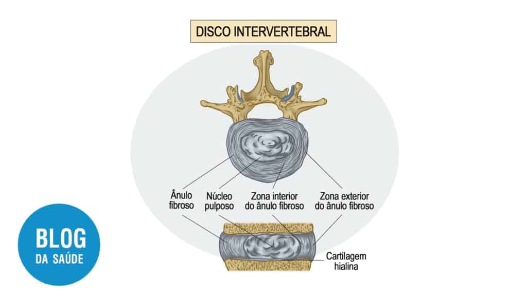 disco intervertebral