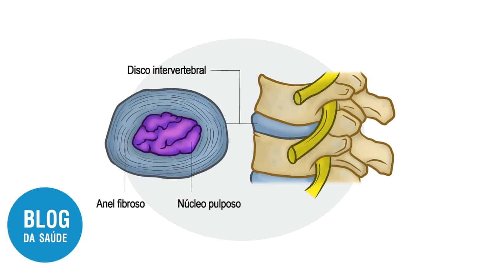 Protrusão Discal Blog Da Saúde