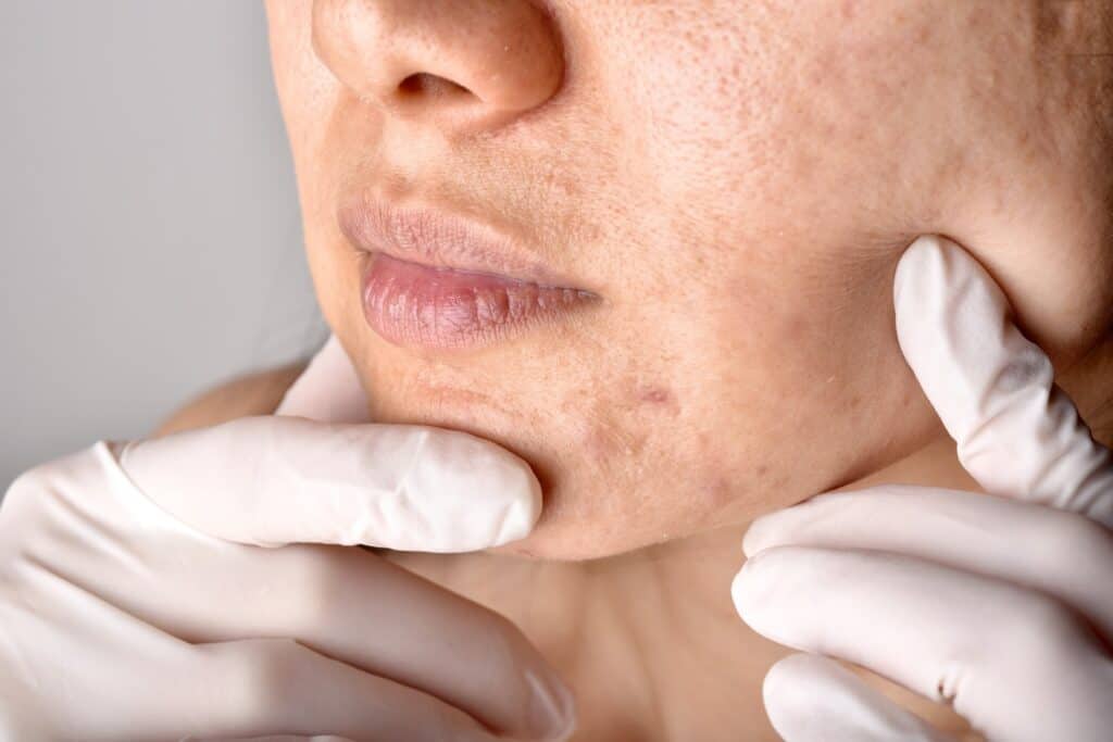 tratamento de cicatriz de acne