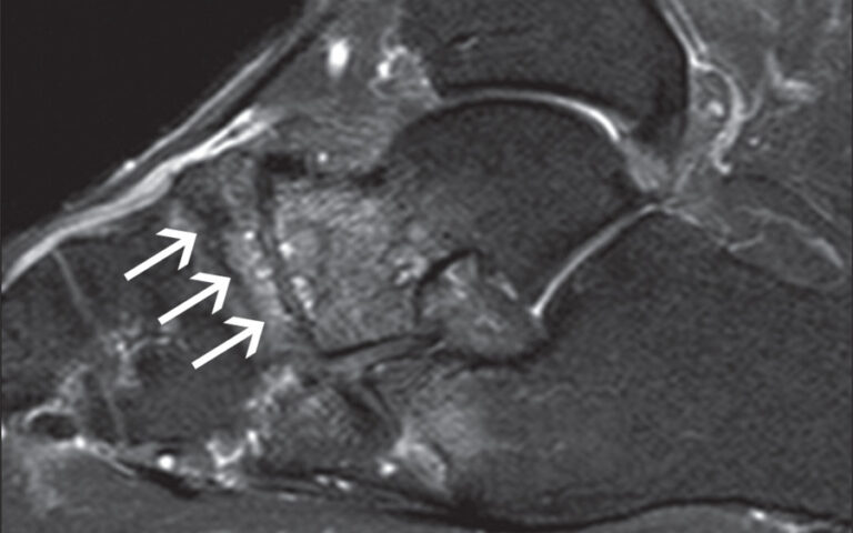 Síndrome de Mueller Weis - Osso Navicular do Pé 2 080c4aedb0df80668478138a0db8d0ea1bce5dee