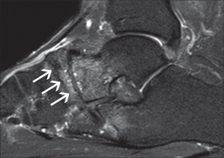Síndrome de Mueller Weis - Osso Navicular do Pé 1 080c4aedb0df80668478138a0db8d0ea1bce5dee