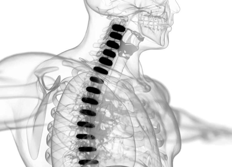 Estenose foraminal: sintomas e tratamento