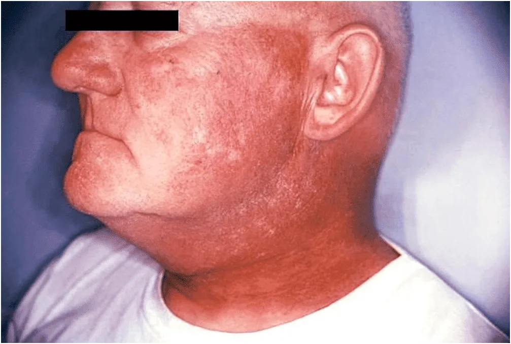 Radiodermite: dermatite por radiação e cuidados 2 image