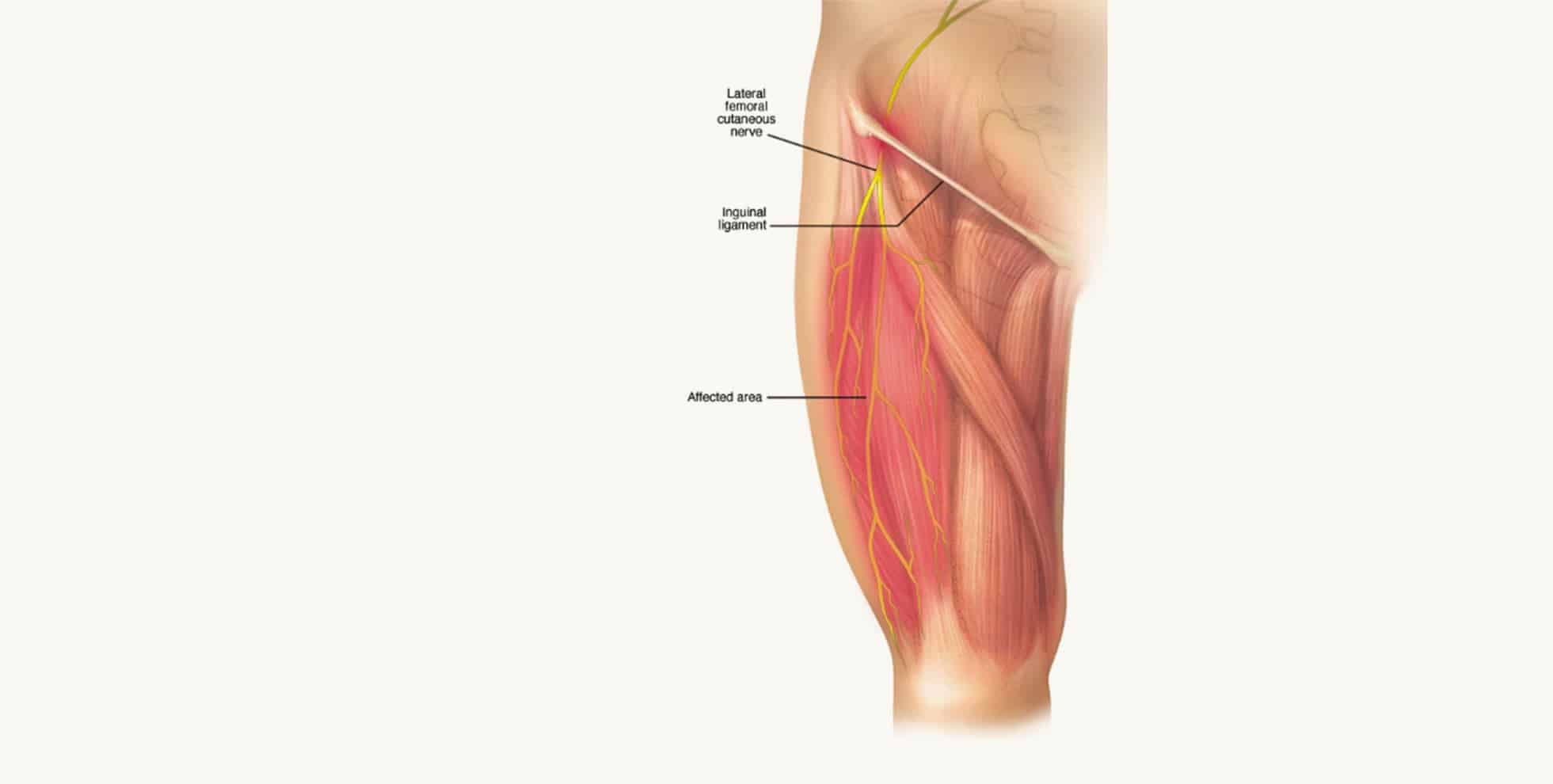 Neuropatia por Compressão: Conheça as Síndromes de Aprisionamento além da Meralgia 16 meralgia parestesica dor