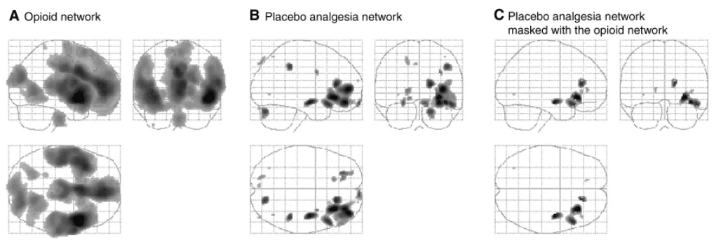 Efeito Placebo e Ressonancia Magnetica Funcional