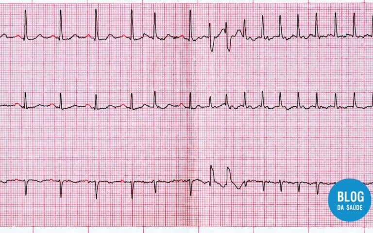 Extrassístole Supraventricular: Entendendo as Palpitações Cardíacas 10 Extrassístole Supraventricular