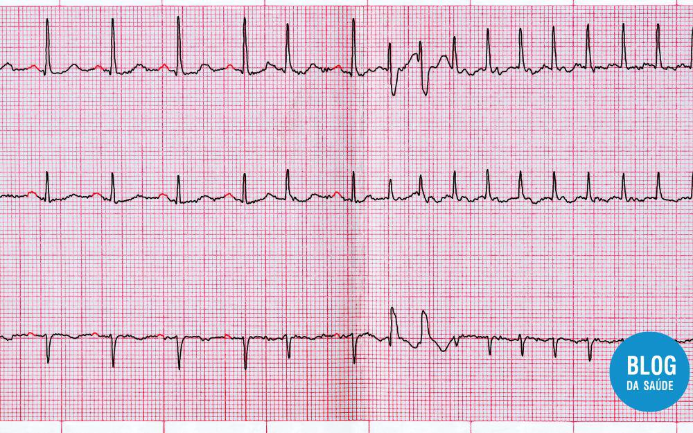 Extrassístole Supraventricular: Entendendo as Palpitações Cardíacas 17 Extrassístole Supraventricular