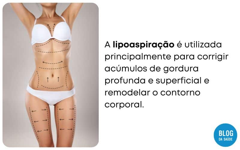 LIPOASPIRACAO O QUE E 1