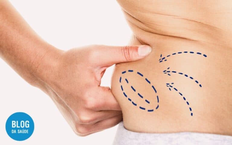 LIPOASPIRAÇÃO