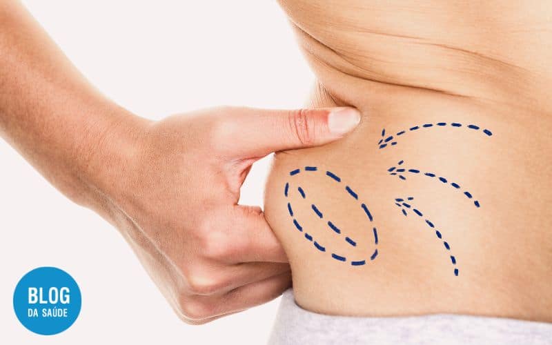 LIPOASPIRAÇÃO