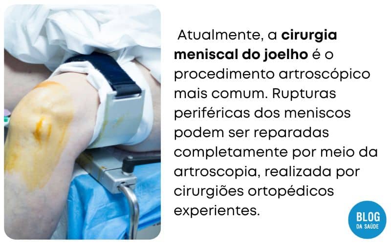 O que é Artroscopia? A Revolução da Cirurgia Minimamente Invasiva 3 O QUE E ARTROSCOPIA 3