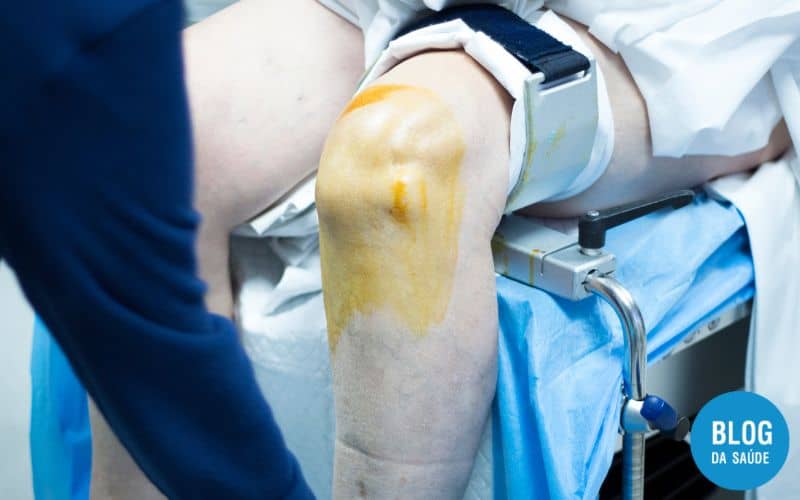 O que é Artroscopia? A Revolução da Cirurgia Minimamente Invasiva 22 O QUE É ARTROSCOPIA