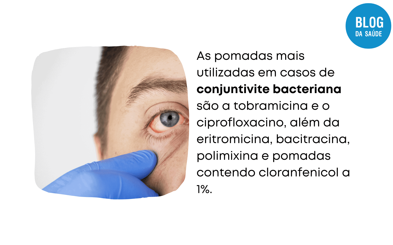 Pomada Para Conjuntivite - Blog Da Saúde