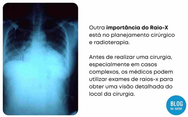 Qual é A Importância Do Raio-X? Para Que Serve? - Blog Da Saúde