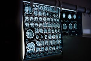 Imagens de ressonância magnética exibidas em negatoscópio