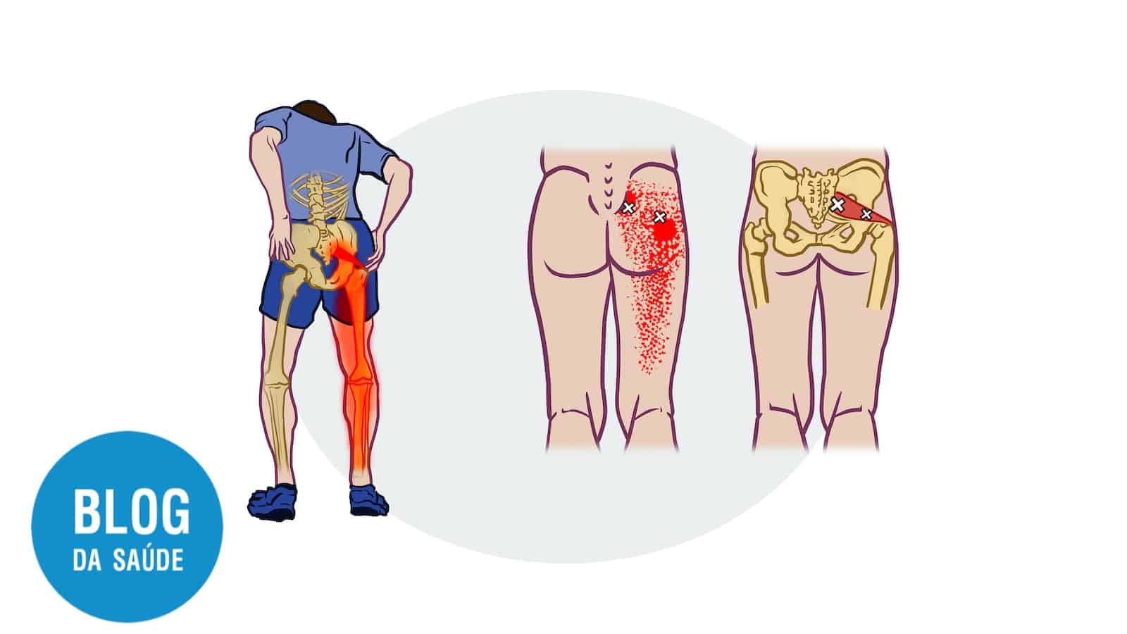 Dor Ciática vs. Pseudociática: Diferenciando as Causas da Dor na Perna 17 SINDROME DO PIRIFORME DOR CIATICA
