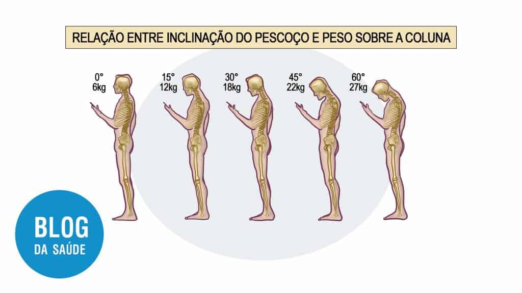 Tensão cervical e angulos no disco