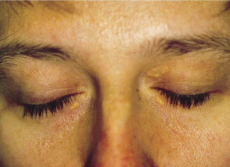 Xantelasma
