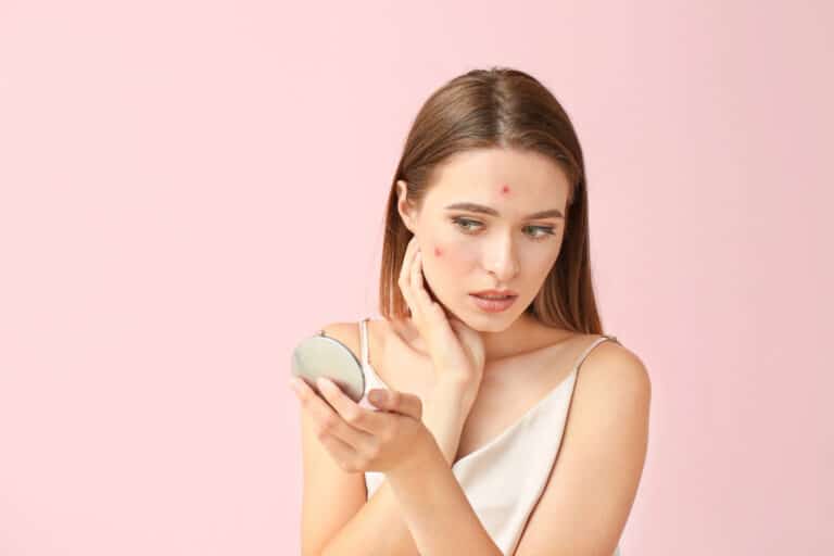 Pessoa com lesões inflamatórias de acne no rosto
