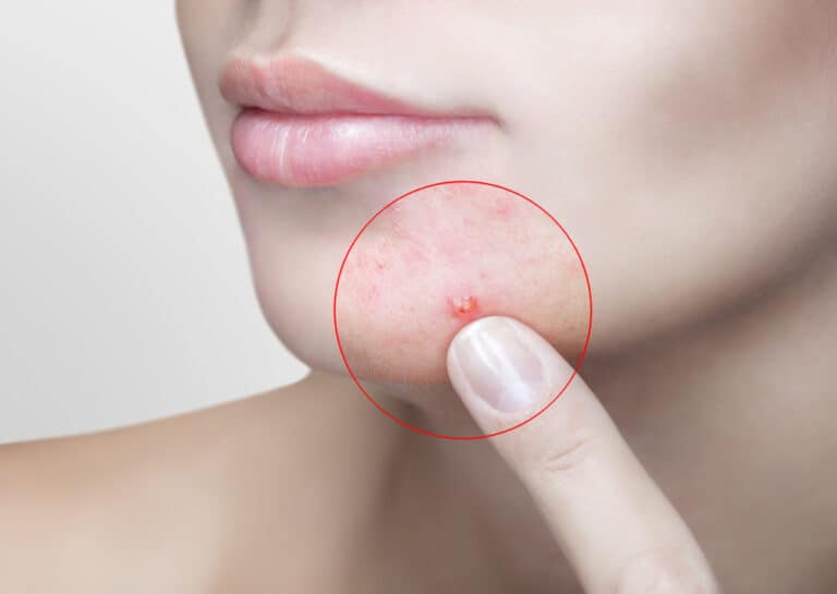Acne no Queixo: Entendendo as Causas e Tratamentos 8 acne no queixo