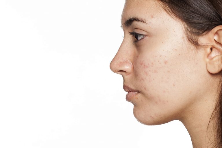 Retinol para acne: benefícios, irritação e cuidados 9 acne tratamento