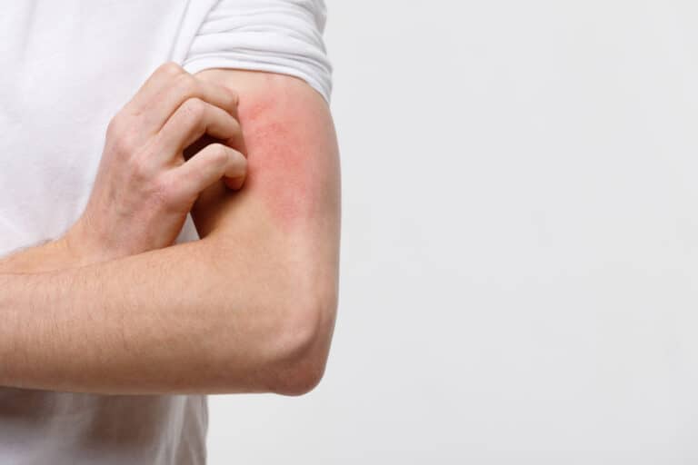 Alergia alimentar ou intolerância: diferenças e sinais de alerta