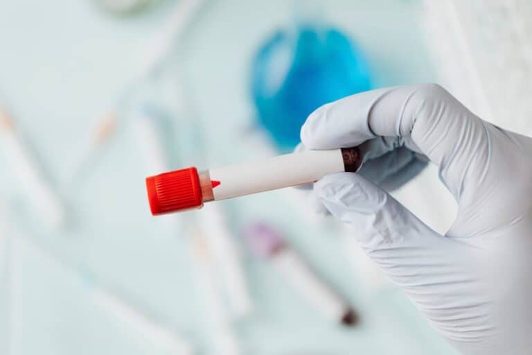 anisocitose exame de sangue hemograma