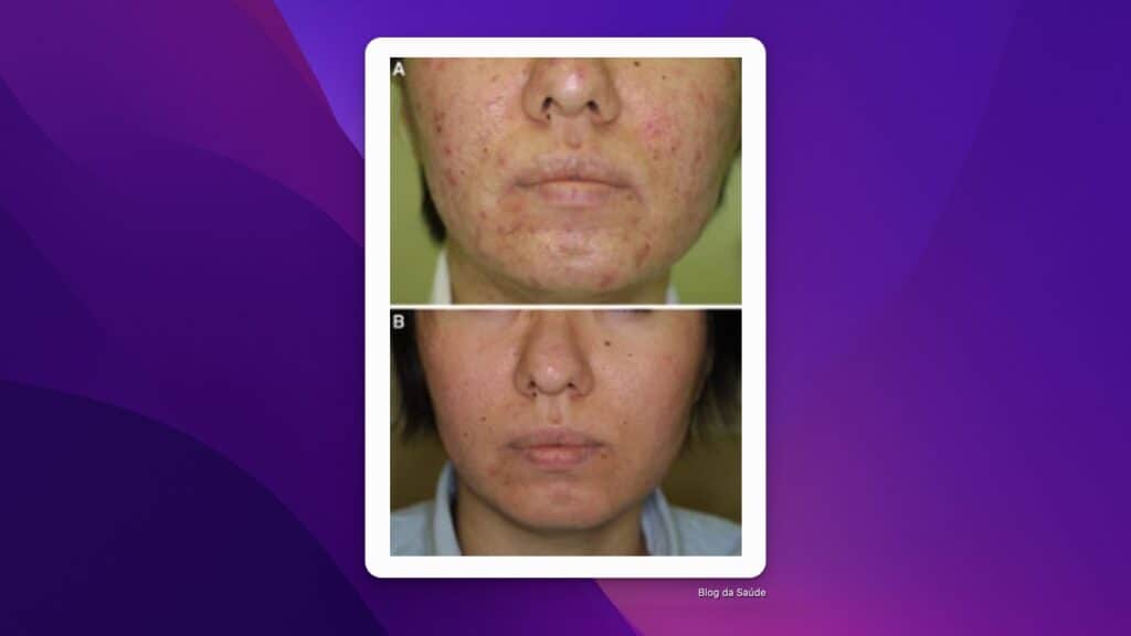 antes e depois espironolactona acne