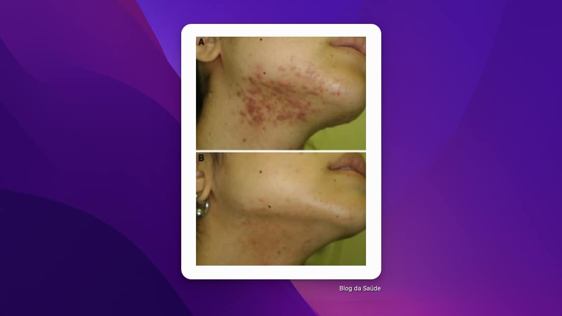 Espironolactona Para Acne Blog Da Saúde