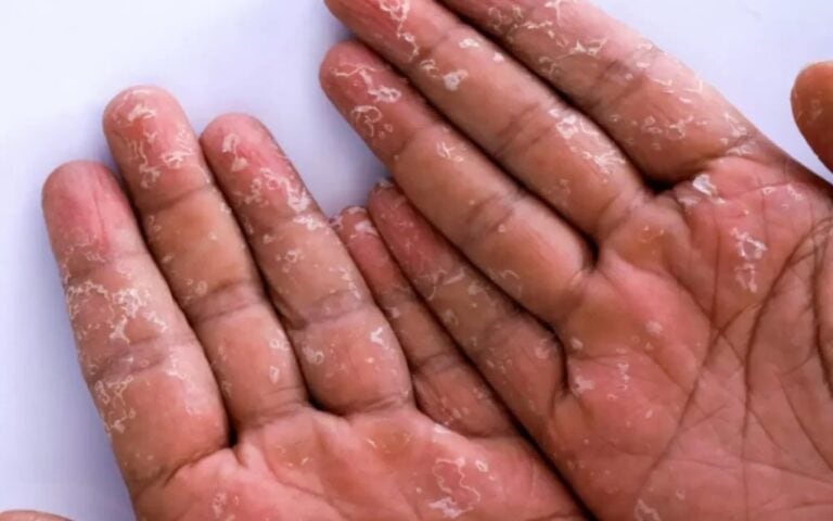 Qual a Melhor Pomada para Disidrose? Guia Completo de Tratamentos 1 bolha nas maos disidrose tratamento