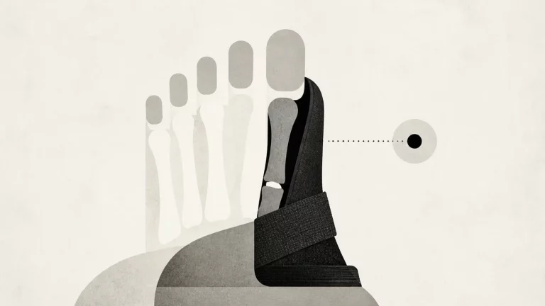 Ilustração editorial abstrata em tons de cinza sobre bota para quinto metatarso fraturado
