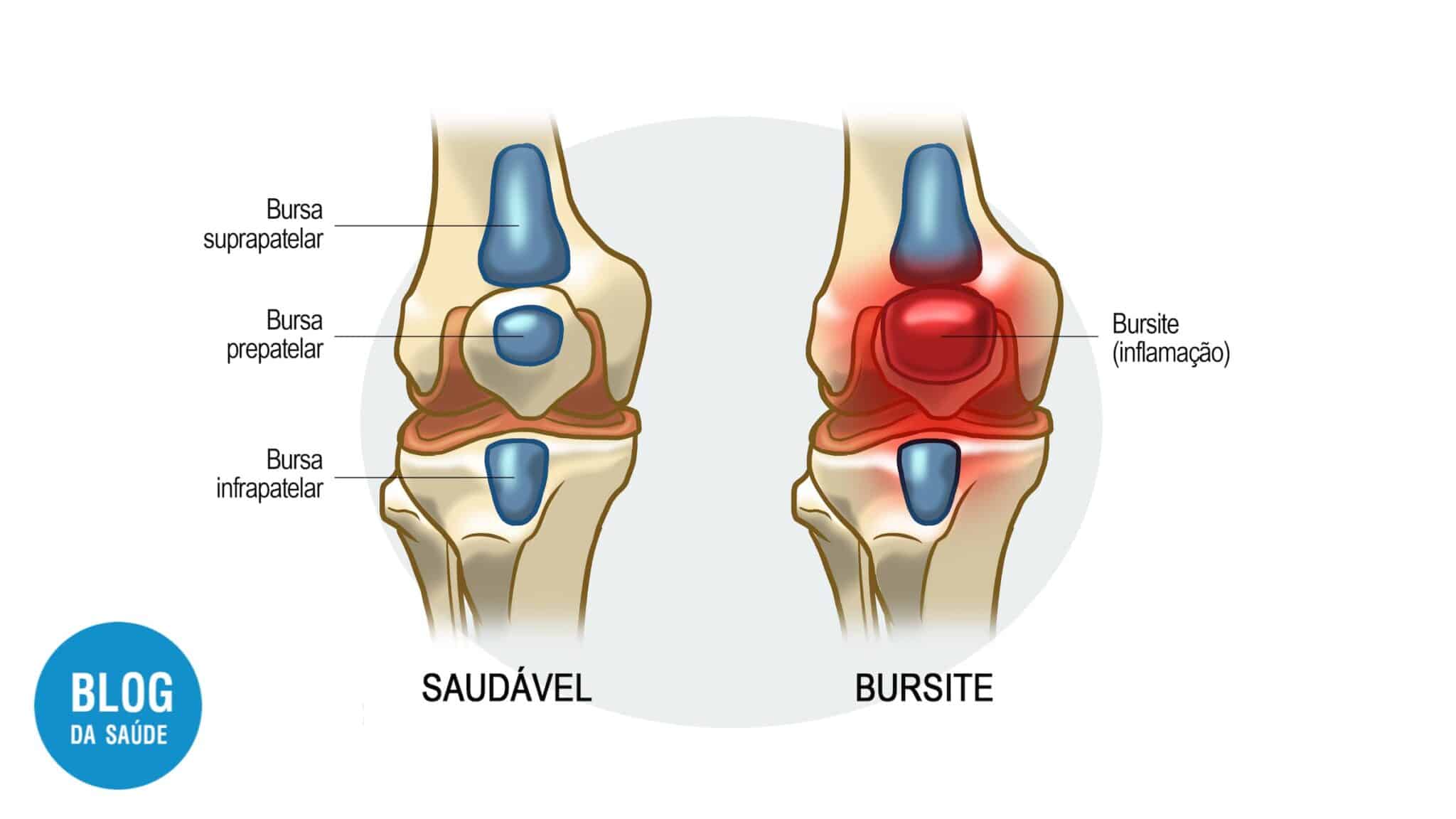 Bursite: O Que é? Sintomas, Causas E Tratamentos - Blog Da Saúde