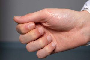O Que É Queloide? Cicatriz Hipertrofica – Causas, Sintomas e Tratamentos