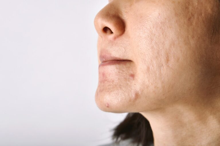 cicatriz de acne