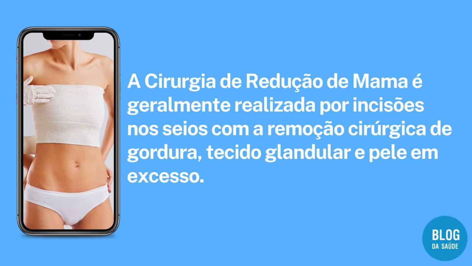 Mamoplastia Redutora Cirurgia Redução De Mama Como é Feita? Blog Da Saúde Mamoplastia Redutora Cirurgia Redução De Mama Como é Feita? Blog Da Saúde