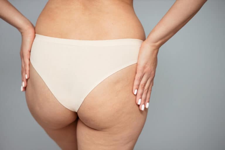 cisto pilonidal