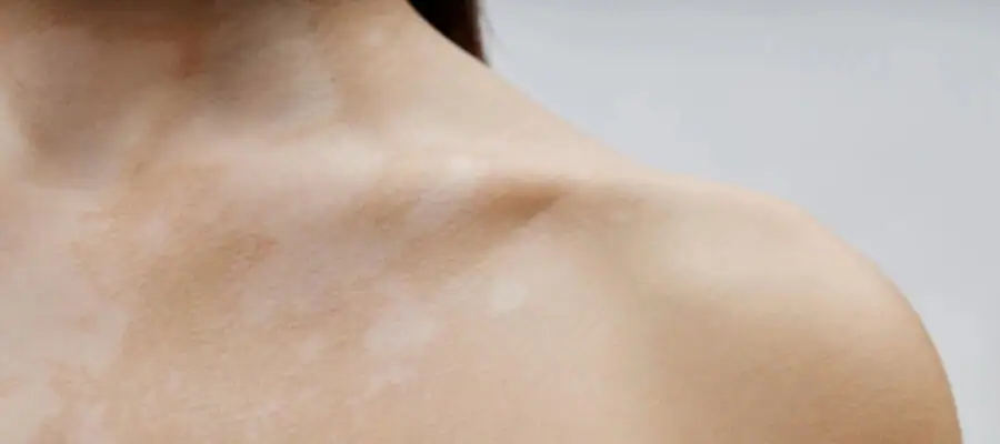 Sardas Brancas (Leucodermia Gutata): O Que São, Por Que Aparecem e Quais os Tratamentos Disponíveis? 3 d89dd8fe466ced6a89b6cccf92ea4565