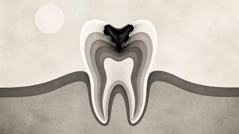 Ilustração editorial abstrata em tons de cinza sobre dente com cárie profunda