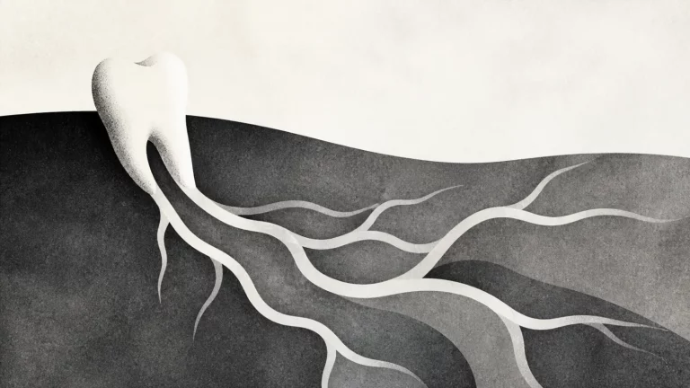 Ilustração editorial abstrata em tons de cinza sobre dente do siso tem raiz